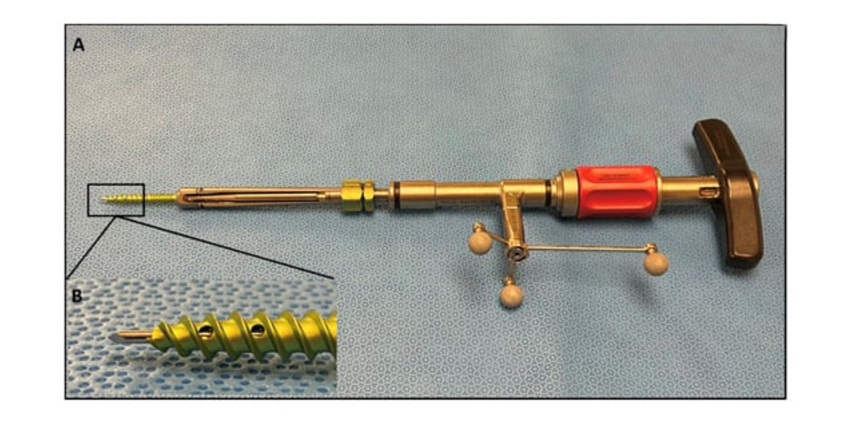 Wireless, 3D NAV Pedicle Screw Placement Review