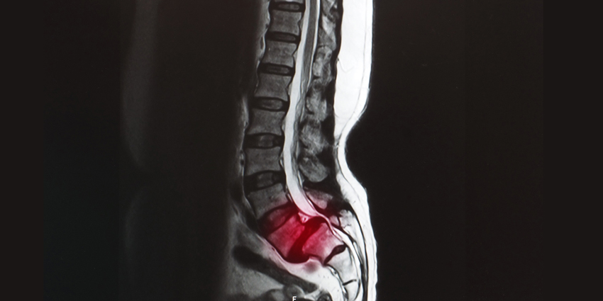 Phase 3 Enrollment Done for 1st Intradiscal Back Pain Injection