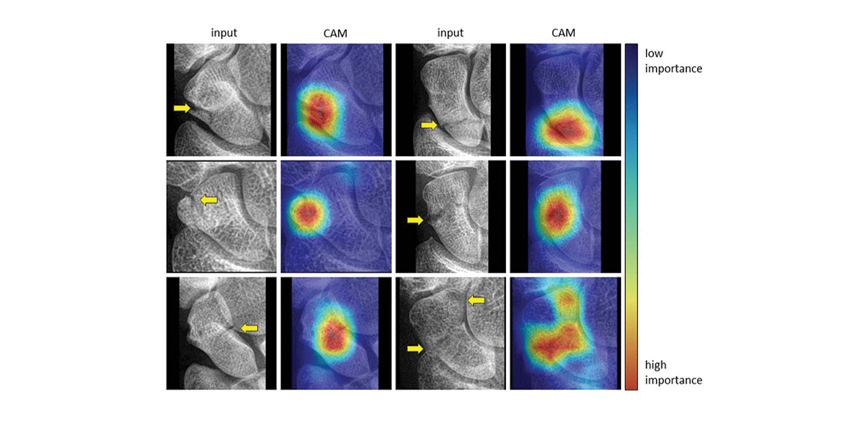 How Accurate Is Artificial Intelligence for Hand/Wrist Diagnosis?