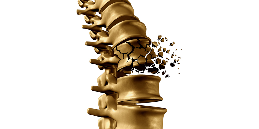 NASS: Vertebral Fracture Guidelines, Appropriate Use Criteria