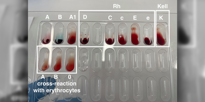 Blood Type Elevates Spondy or ASD Risk?!