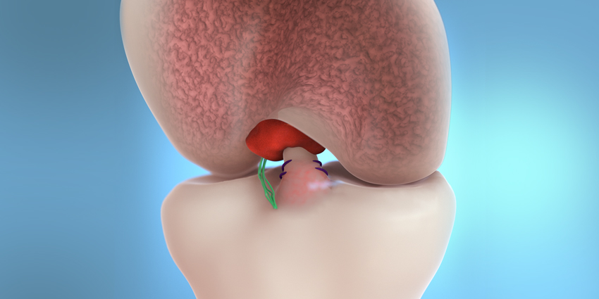 Miach Orthopaedics: 4,000 Patients and Counting