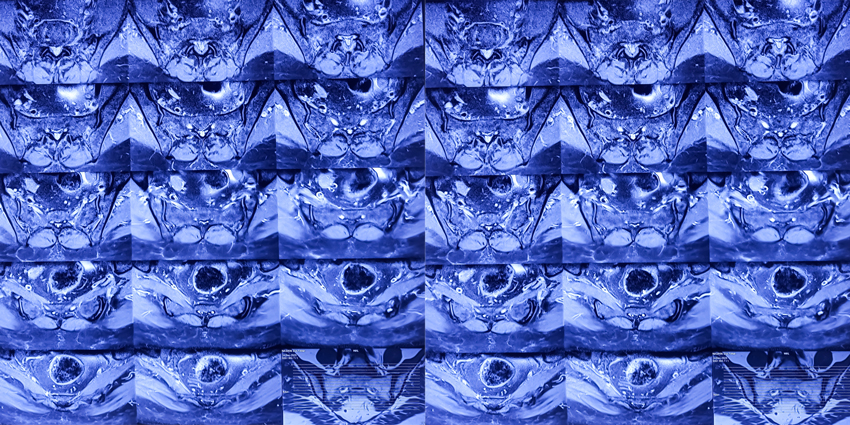 As SI Joint Treatment Options Grow, So Does Controversy