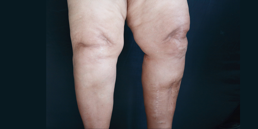 TKA: Obesity Up—But Outcomes Are Better!?