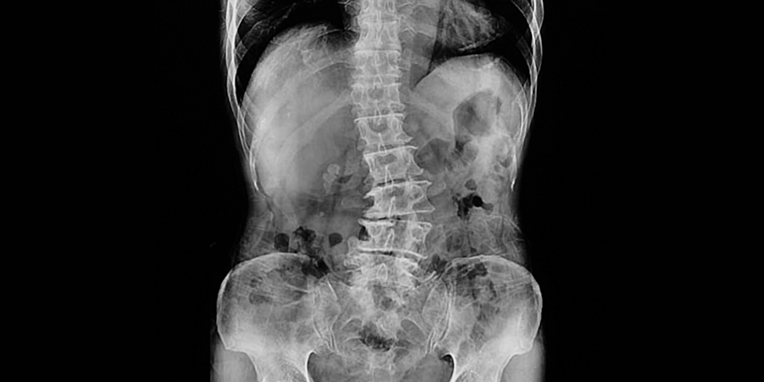 NEW Study: Longer Spine Surgery, Faster Complications?
