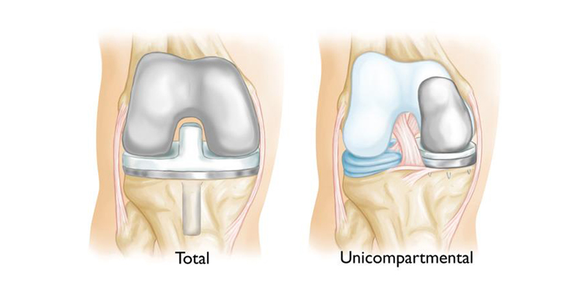 Is Unicompartmental Knee Having a Moment?