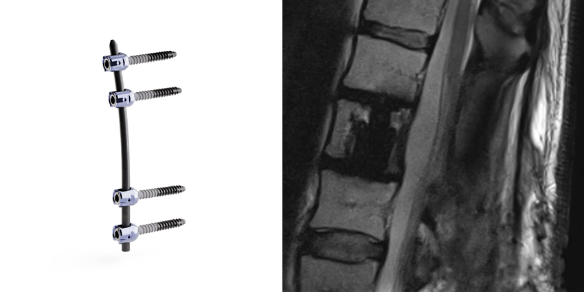 FDA Clears Implants for Spinal Tumors/Infection Revisions