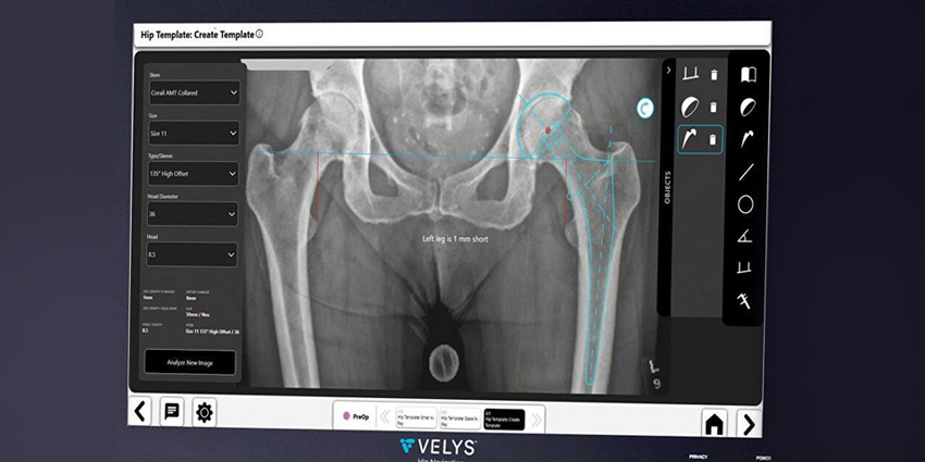 Fluoro NAV Cuts THA OR Time and Readmission: New Study