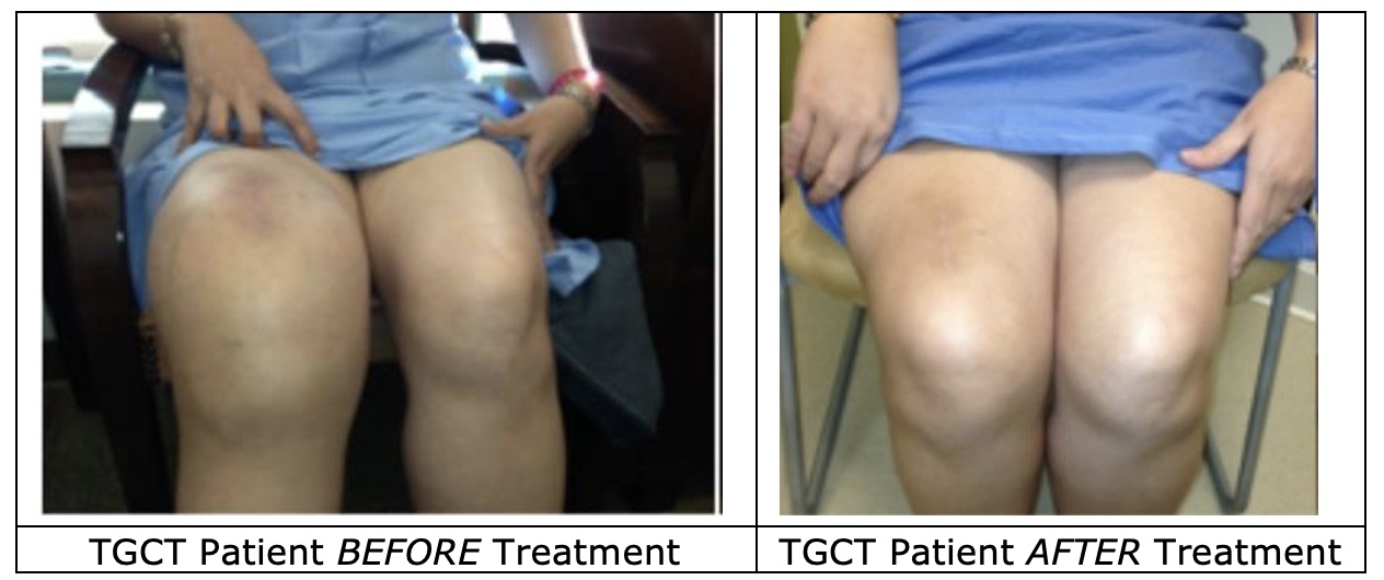 When Surgery Isn’t an Option, This Knee Tumor May Still Be Treated