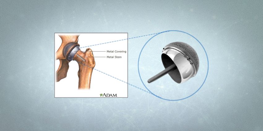 Hip Resurfacing: Older Patients vs Younger Patients