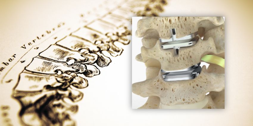 High BMI Cervical Disc Arthroplasty Study Published