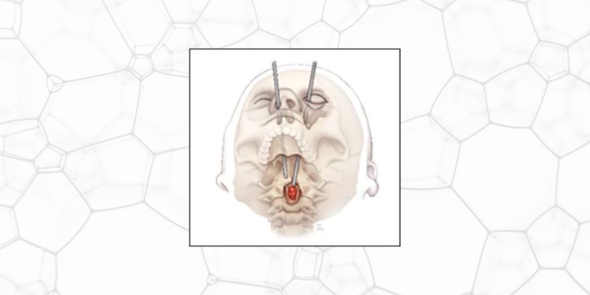 Removing a Spinal Tumor Through Eye Socket