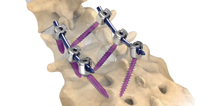Verdict Against NuVasive in Patent Dispute