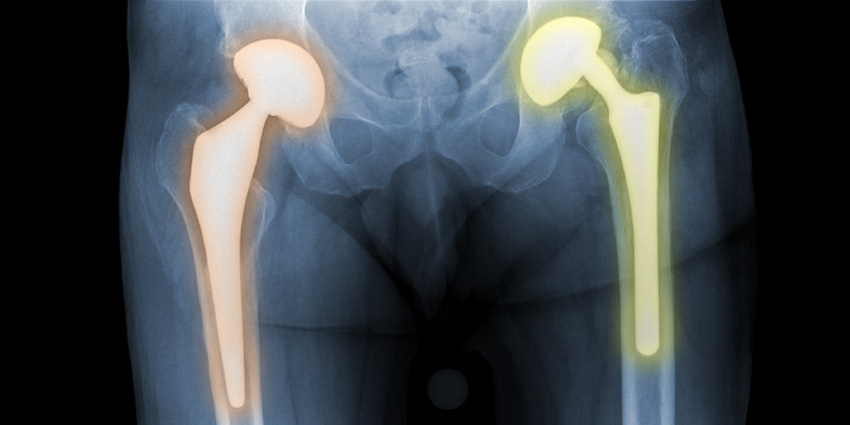 Second Hip Replacement: Pretty Much Like the First?