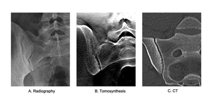 Better Cervical Imaging With Digital Tomosynthesis?