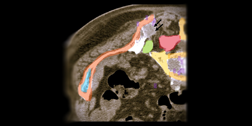 New Study Tests Heat Modalities for Tumor Ablation