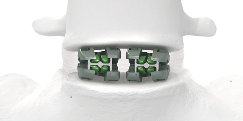 FDA Grants 510(k) Clearance for MRI-Compatible Interbody Implant