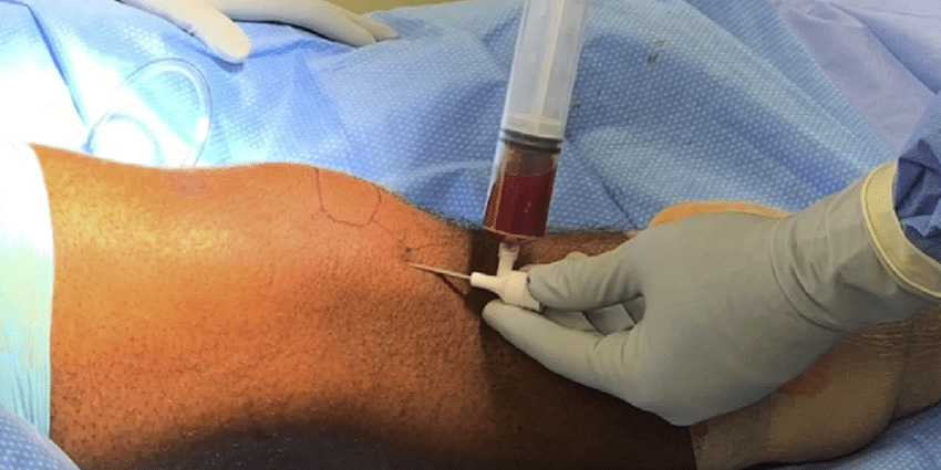 Knee Aspiration May Delay ACL Scar Tissue