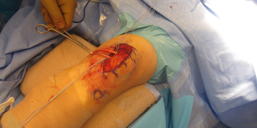 What’s Behind the Drop in Pediatric ACL Surgeries?