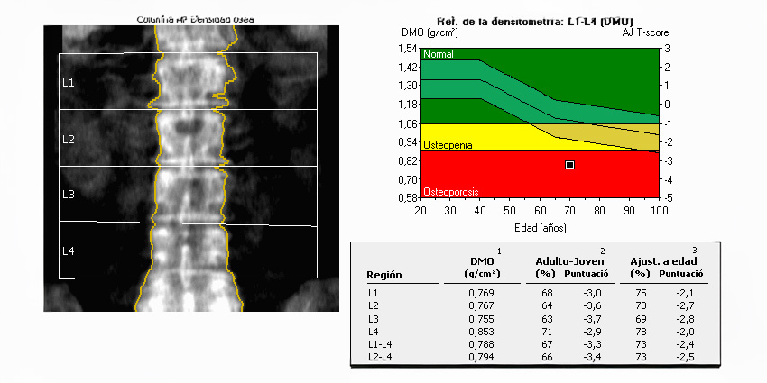 Case Study Highlights DXA Diagnostic Scan Pitfalls
