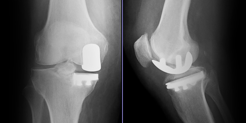 Cementless Uni Arthroplasty Tied to Higher Fracture Risk