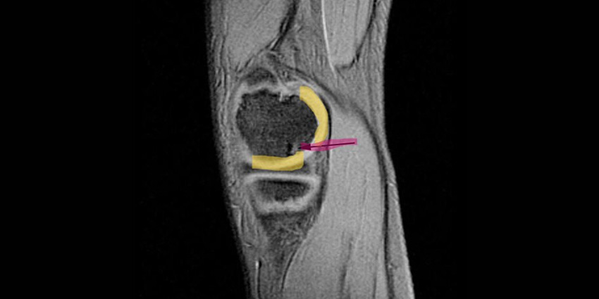 PRP + HA: Tag Team Tackles Knee OA Edema