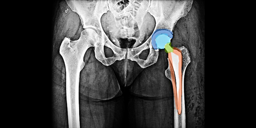 Primary Stems in Hip Revisions: Old Friend or False Hope?