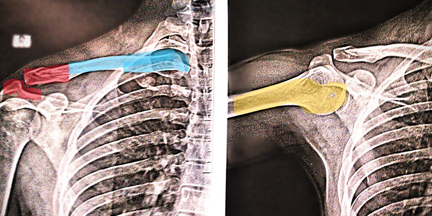 Do All Broken Collarbones Need a Surgeon?…Maybe Not