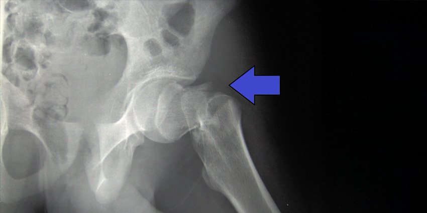 Can Orthopedic Surgeons Fix More Than Broken Hips?