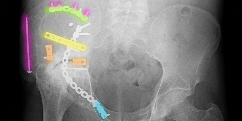 Testosterone: Unexpected Hero for Preventing Hip Fractures?