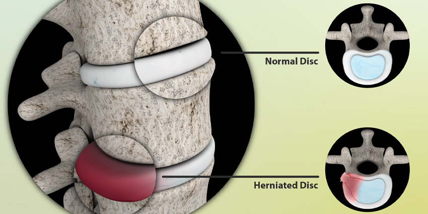 Spontaneous Disc Resorption: The Lumbar Spine Comeback Kid