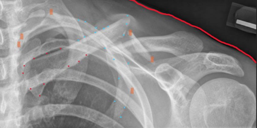 Pediatric Clavicle Fractures: Why More Hospital Admissions?