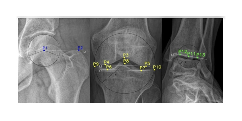 Deep Learning in Action: Automated Limb Alignment Assessment
