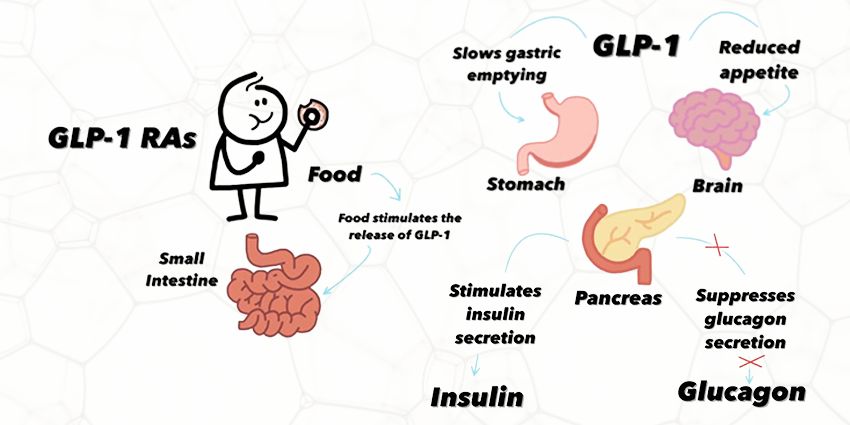 Should GLP-1 Be in Your Preop Toolkit—or Not?