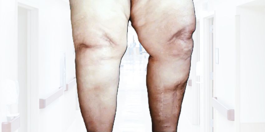 TKA in Patients With BMI ≥50: New Insights