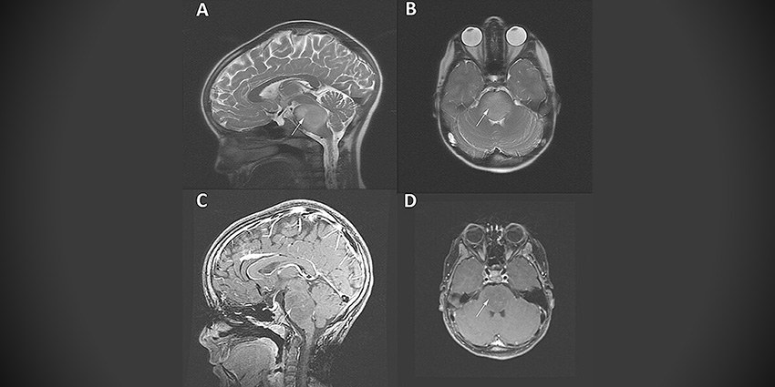 Out of Sight, Out of Clinic: New Study About Kids With TBI