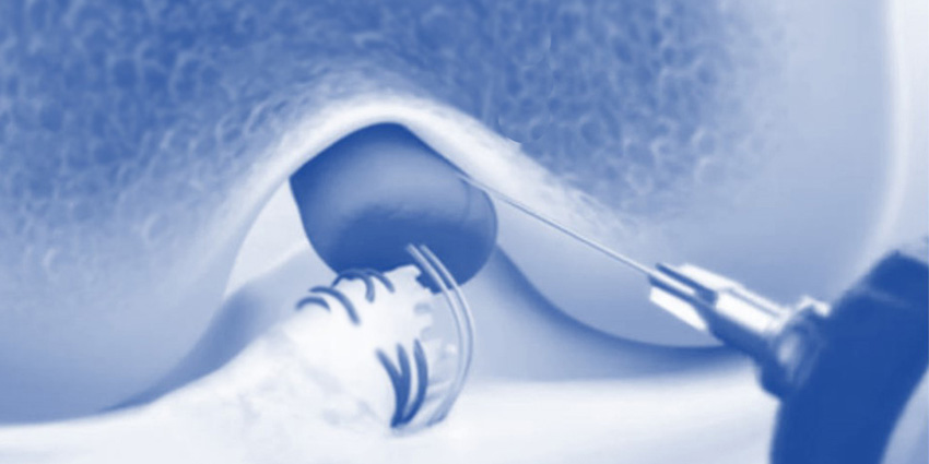 Reinforced Bioinductive Implants: New Secret Weapon?