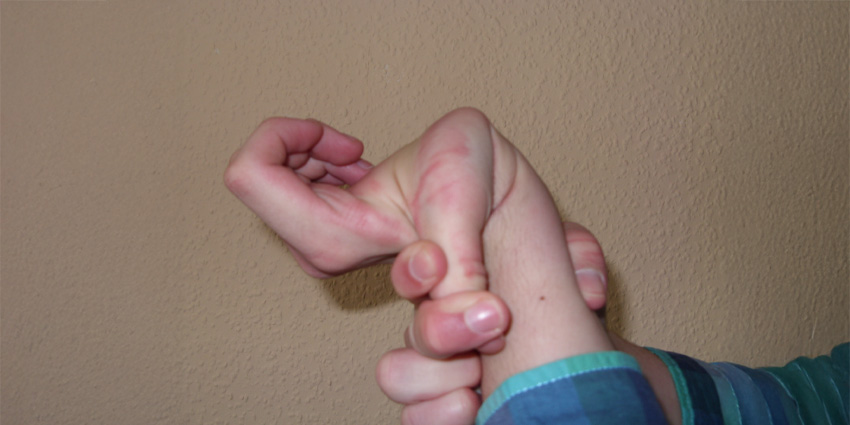 The Loose Truth: Unraveling Hypermobile Ehlers-Danlos in the OR