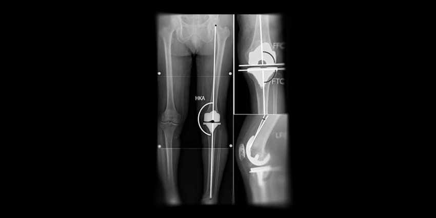 Kinematic vs Mechanical In TKA…Drumroll…No Difference
