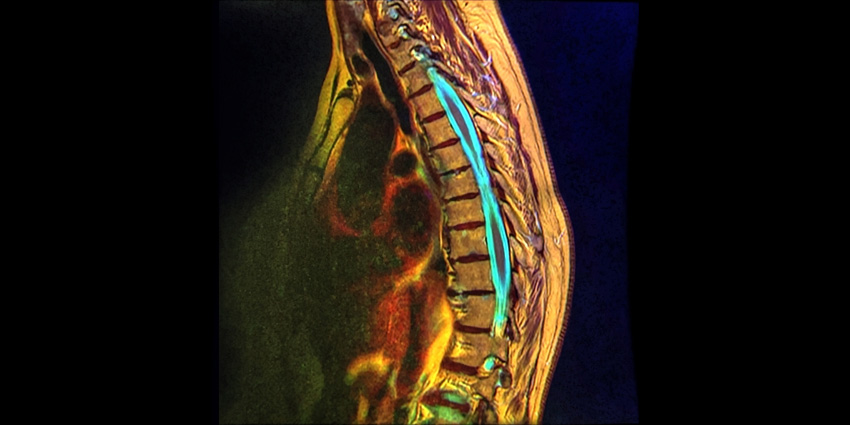 MRI or PROMIS / ODI for Spine Diagnostics?