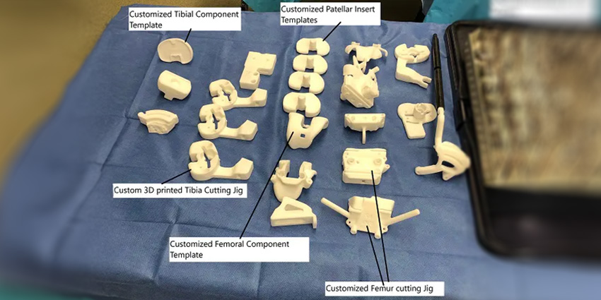 TKA: When ‘One Size Fits All’ Gets Shown the Door