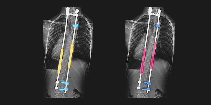 Growing Rods: Is the Second Surgery Worth It?
