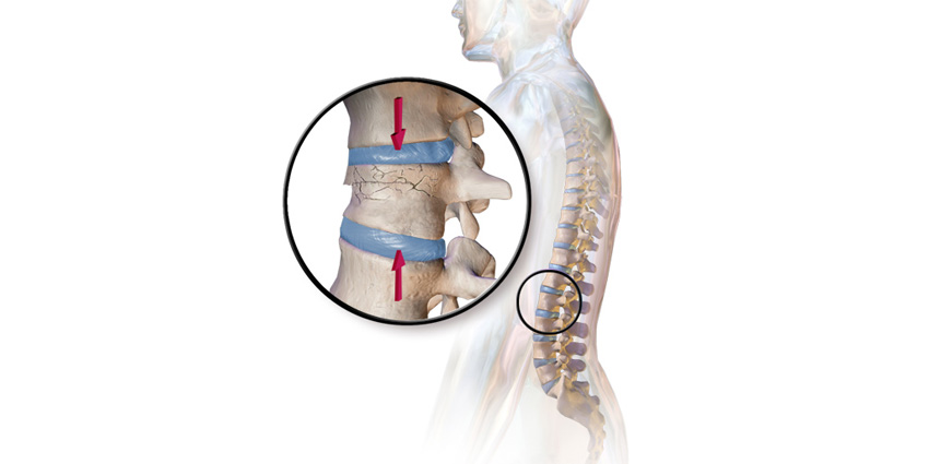 NASS Drops the Hammer on Osteoporotic Compression Fracture Care