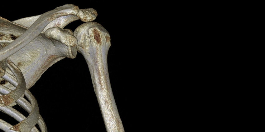 Avoiding the Walk of Shame in Reverse Shoulder Arthroplasty