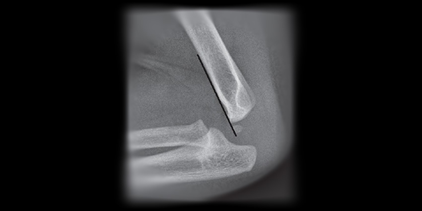 Fuzzy X-Ray? A New Clue for Nerve Injuries in Pediatric Elbows