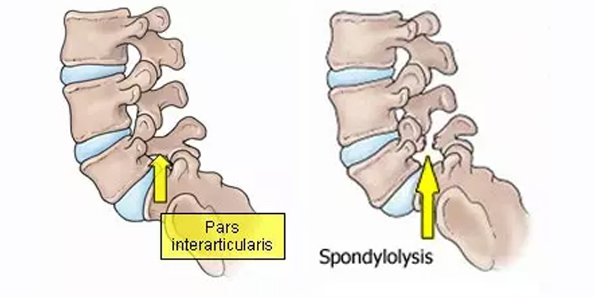 Robotic Pars Repair + r-BMP: Back in Action at 12 Weeks