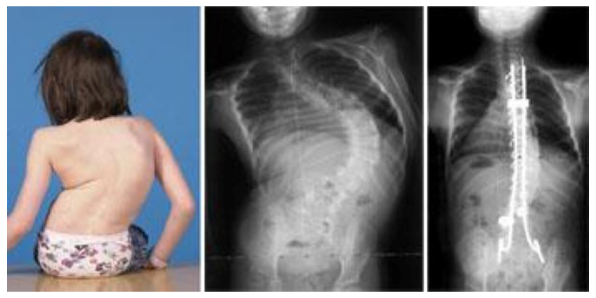 Frailty in Six Questions: A New Compass for Pediatric Deformity Surgery