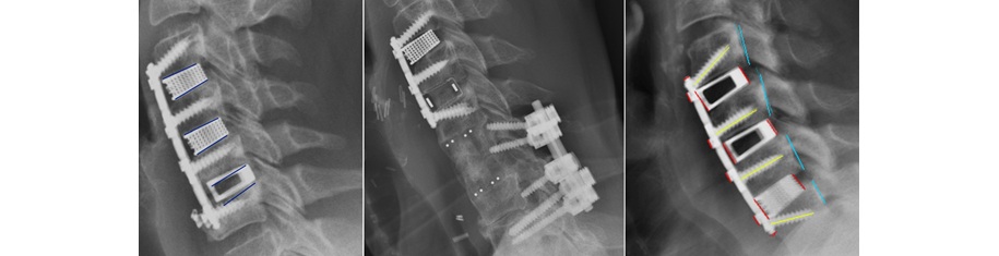 Nexus Spine’s Patented Tranquil® Interbody Implants Achieve Exceptional Outcomes