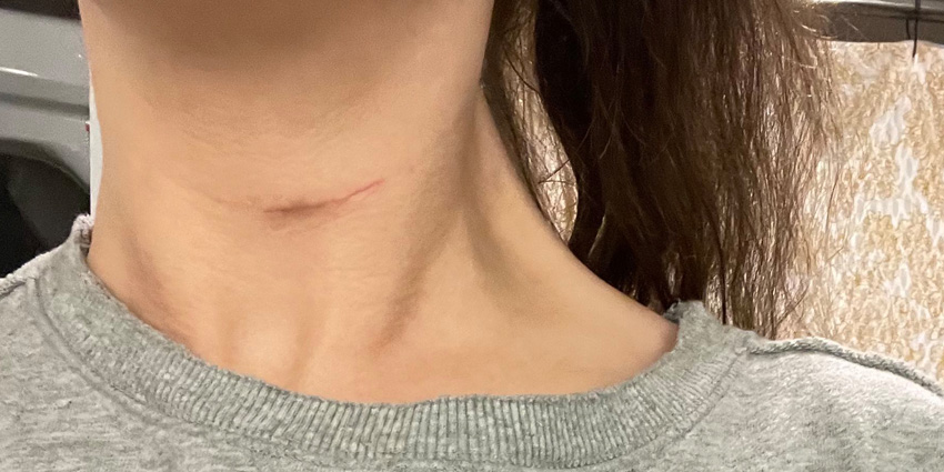 Cervical Disc Replacement: ‘Weaker’ Patients May Win Bigger