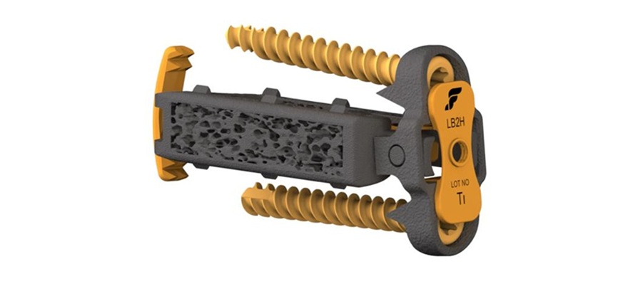 Foundation Surgical Announces First-Ever Surgery Using the Interwedge® Standalone Lateral Implant System